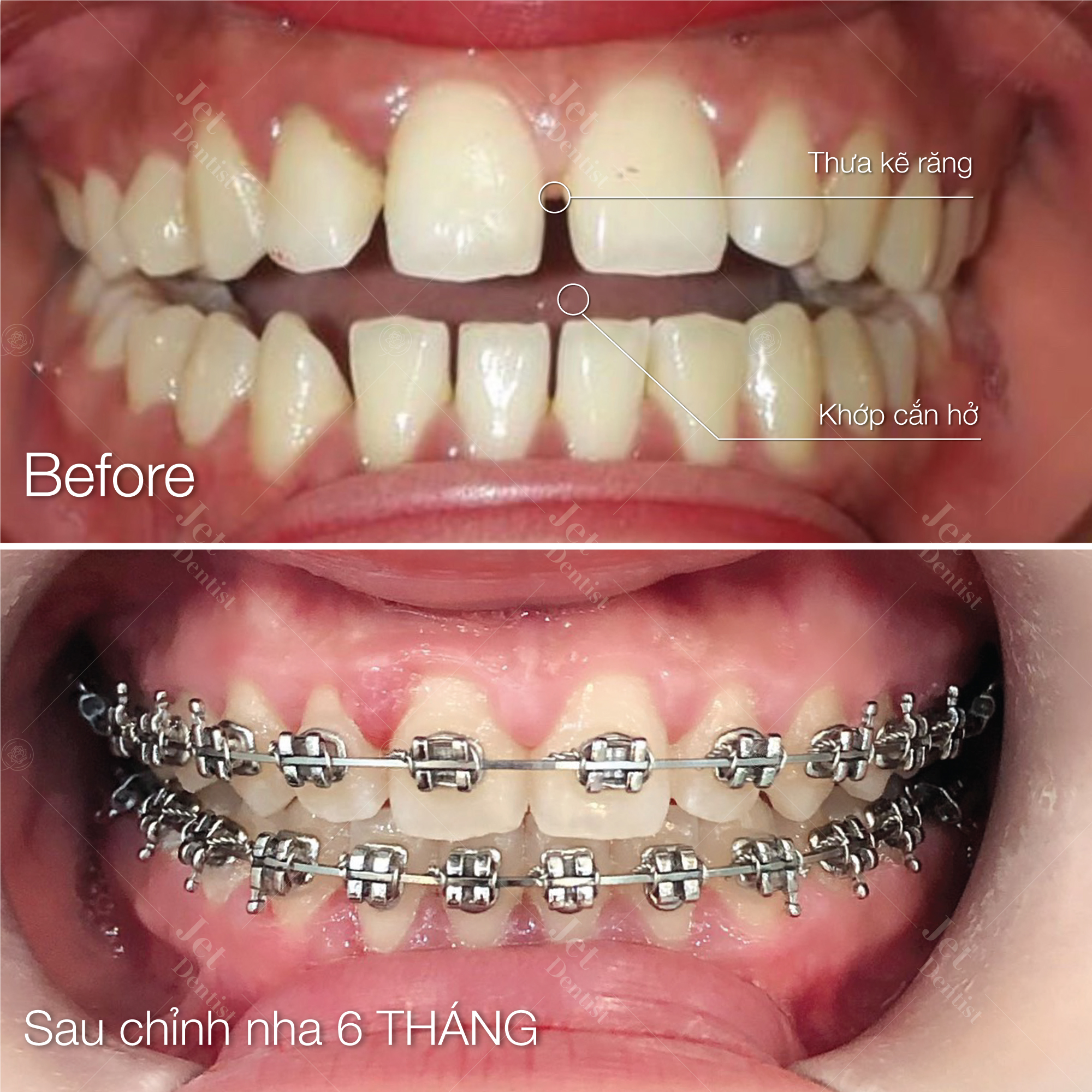 Siết răng khi niềng là gì? Siết răng tại nha khoa Anh Đức diễn ra như thế nào?