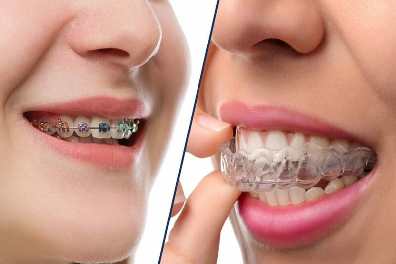 Siết răng khi niềng là gì? Siết răng tại nha khoa Anh Đức diễn ra như thế nào?