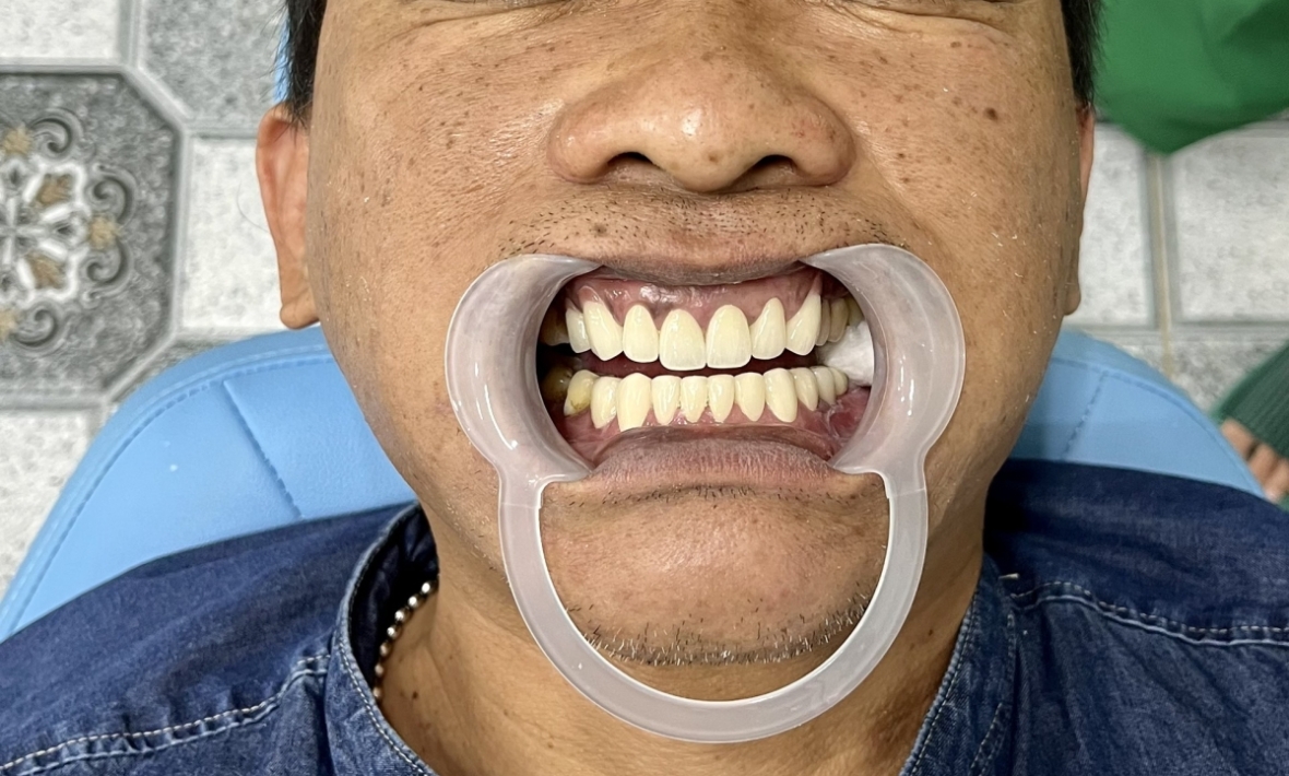 ZIRCONIA, Thẩm mỹ nụ cười với 22 răng toàn sứ