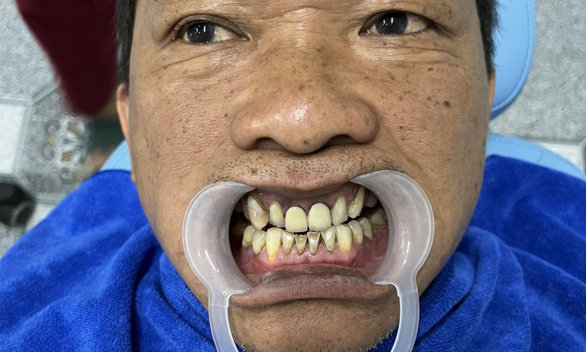 ZIRCONIA, Thẩm mỹ nụ cười với 22 răng toàn sứ