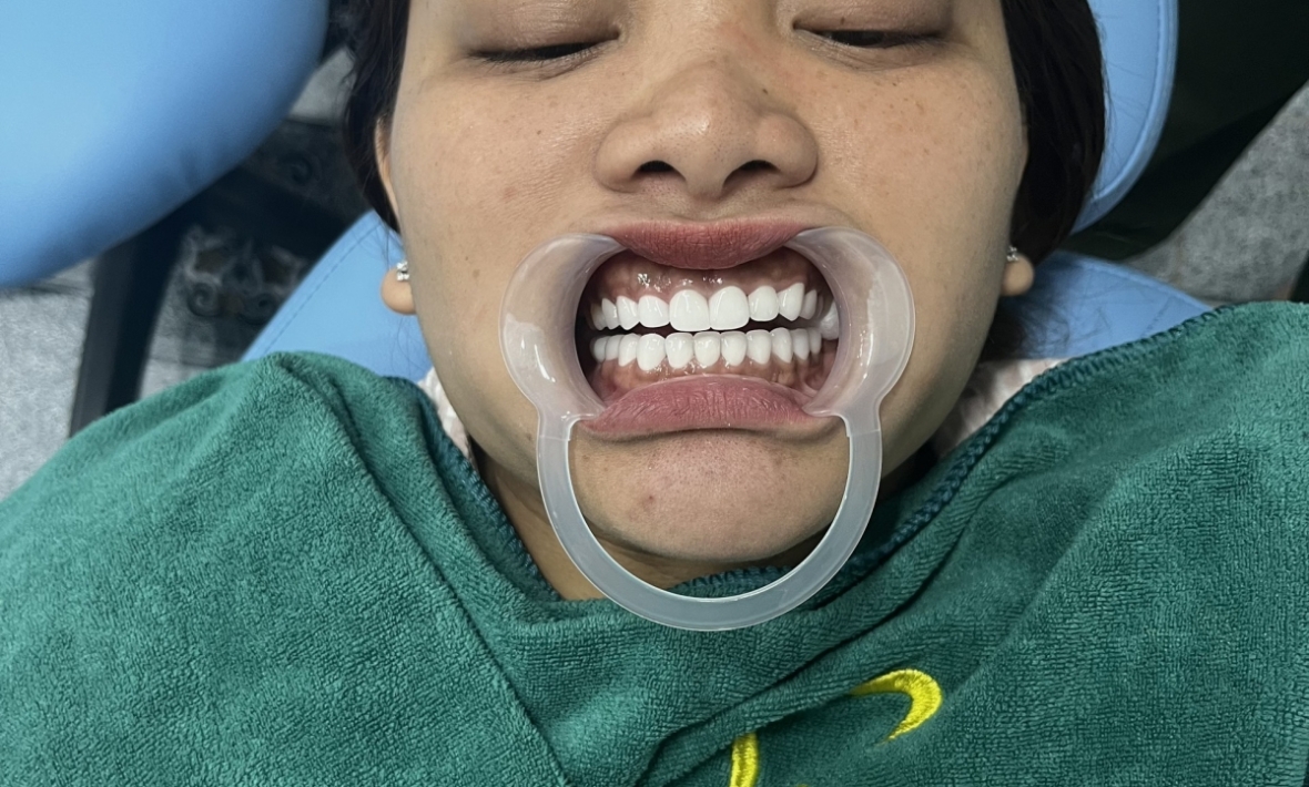 Dán sứ cho chị khách , thẩm mỹ nụ cười 21 răng 