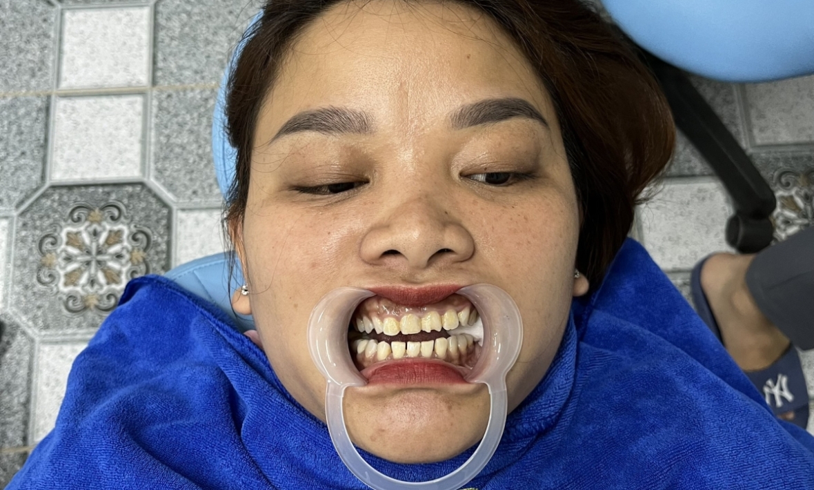 Dán sứ cho chị khách , thẩm mỹ nụ cười 21 răng 