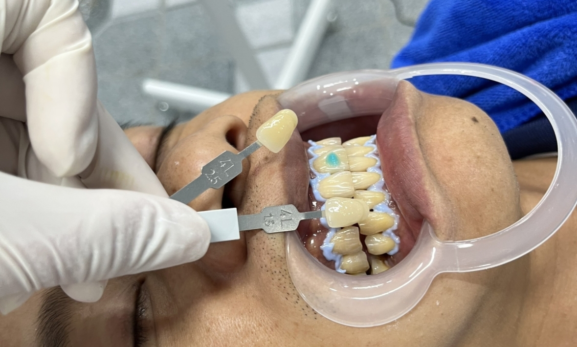 Tẩy trắng đẹp