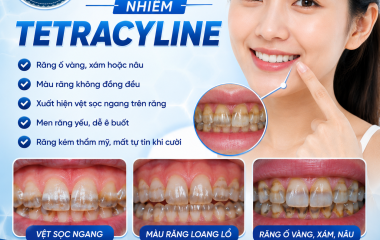 Dấu hiệu nhận biết răng nhiễm Tetracyline