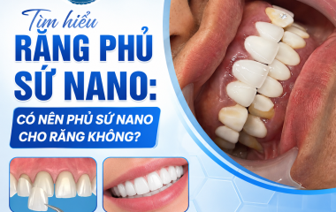 Tìm hiểu răng phủ sứ nano: Có nên phủ sứ nano cho răng không?