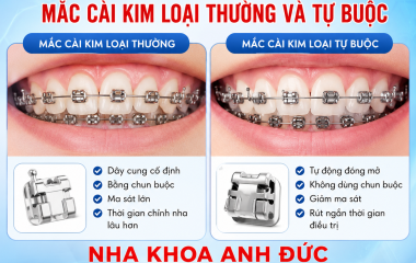 So sánh mắc cài kim loại thường và tự buộc