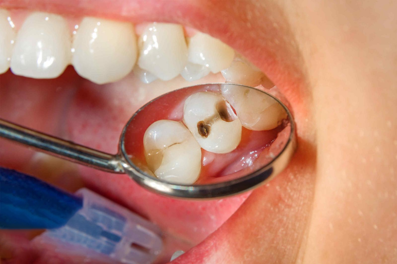Điều trị tủy răng tại Nha khoa phường Trung Mỹ Tây