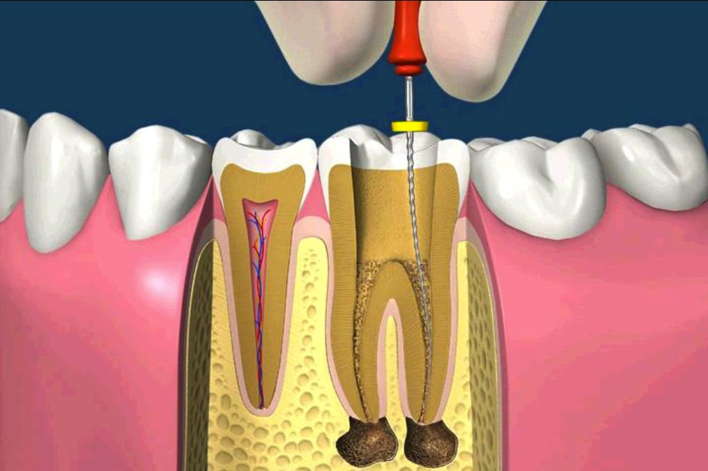 Nha khoa Anh Đức – Địa chỉ điều trị tủy răng uy tín tại phường Trung Mỹ Tây