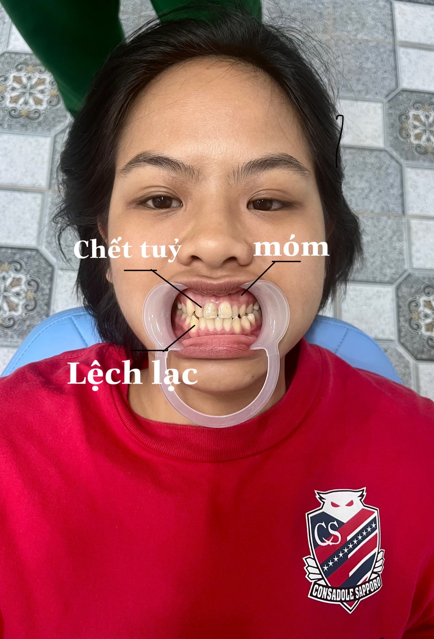 Hình ảnh khách hàng trước khi bọc răng sứ