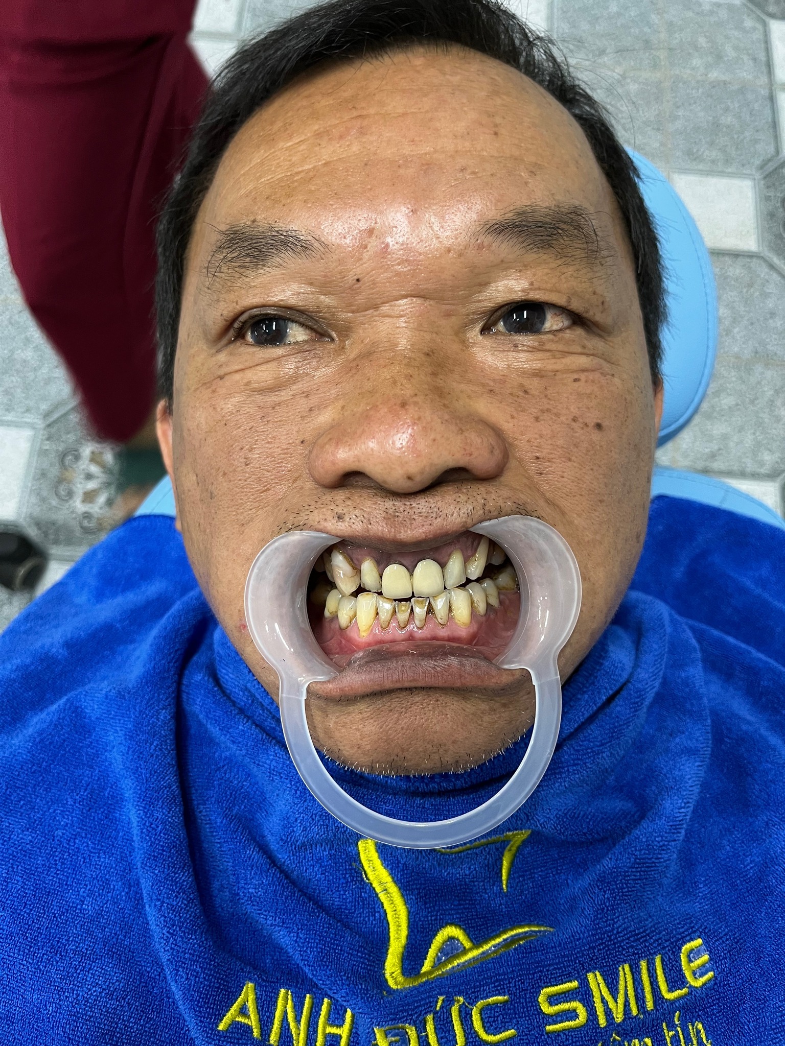 Hình ảnh khách hàng trước khi bọc răng sứ