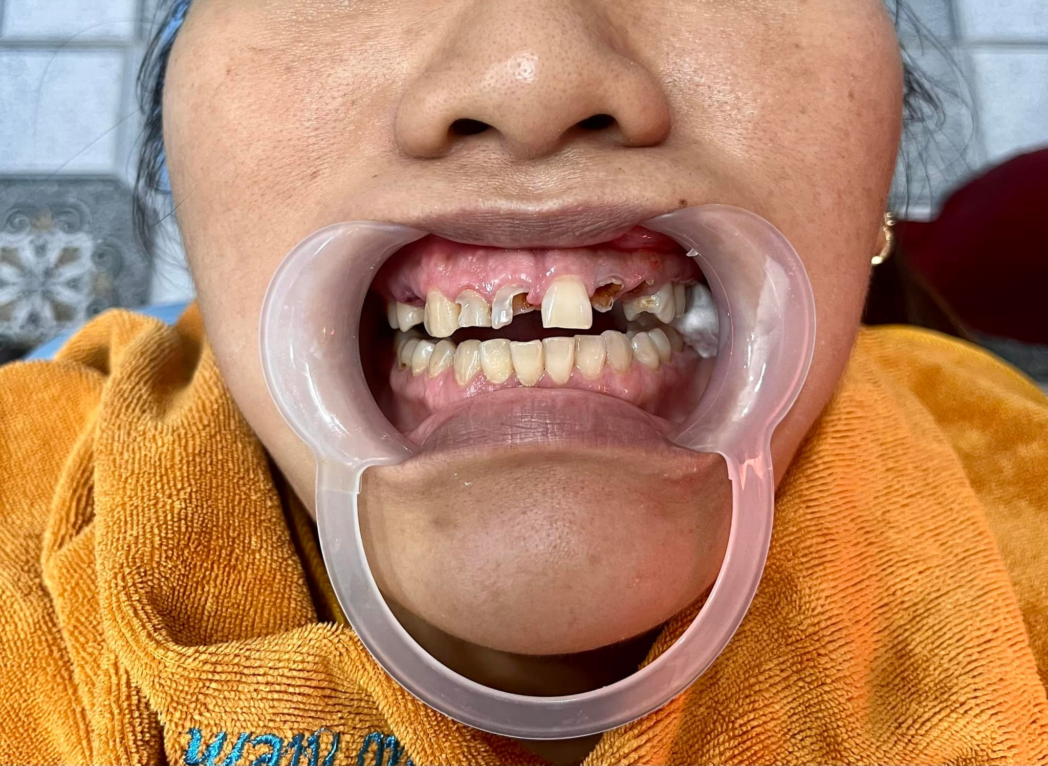 Khi nào nên bọc răng sứ thẩm mỹ tại nha khoa quận 12?