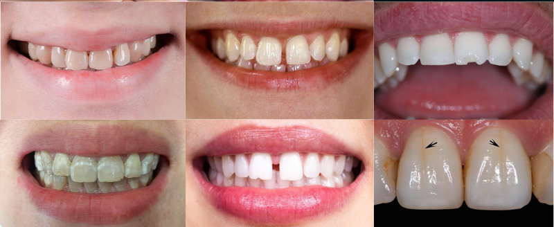 Những trường hợp nên dán sứ Veneer thẩm mỹ