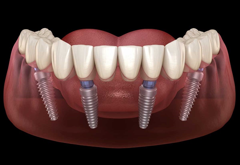 Trồng răng Implant All-on-4 là kỹ thuật phục hình răng toàn hàm hiện đại nhất hiện nay