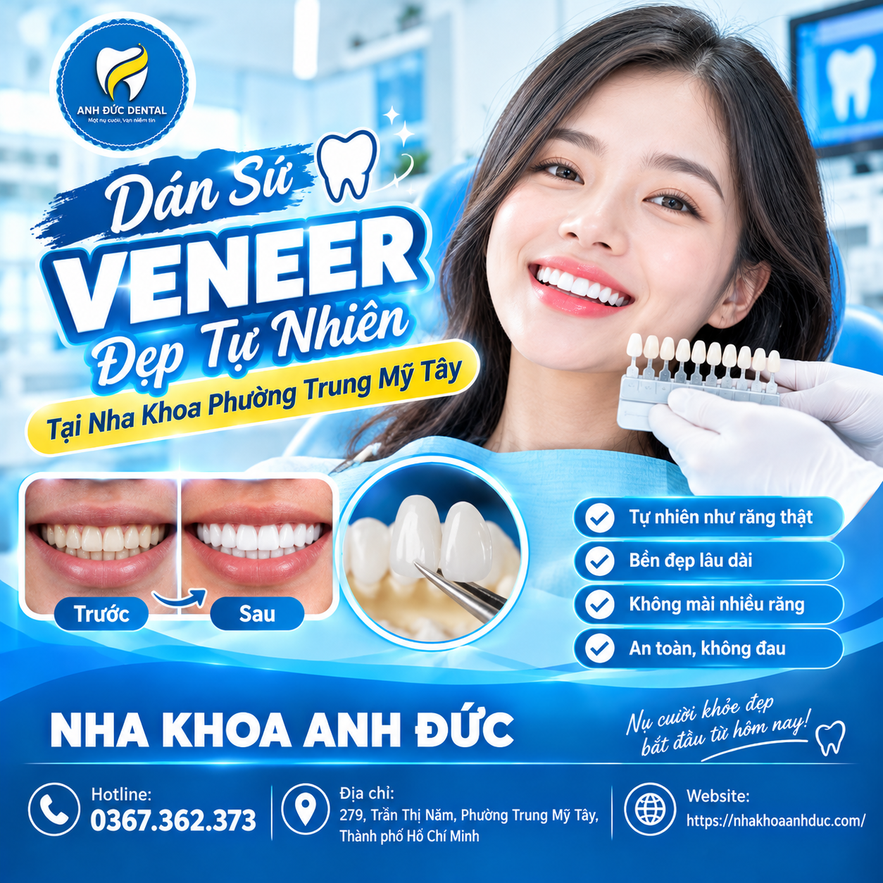 Dán Sứ Veneer Đẹp Tự Nhiên Tại Nha Khoa Phường Trung Mỹ Tây