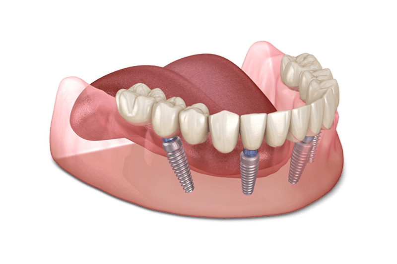 Ưu điểm của phương pháp trồng răng Implant All-on-4