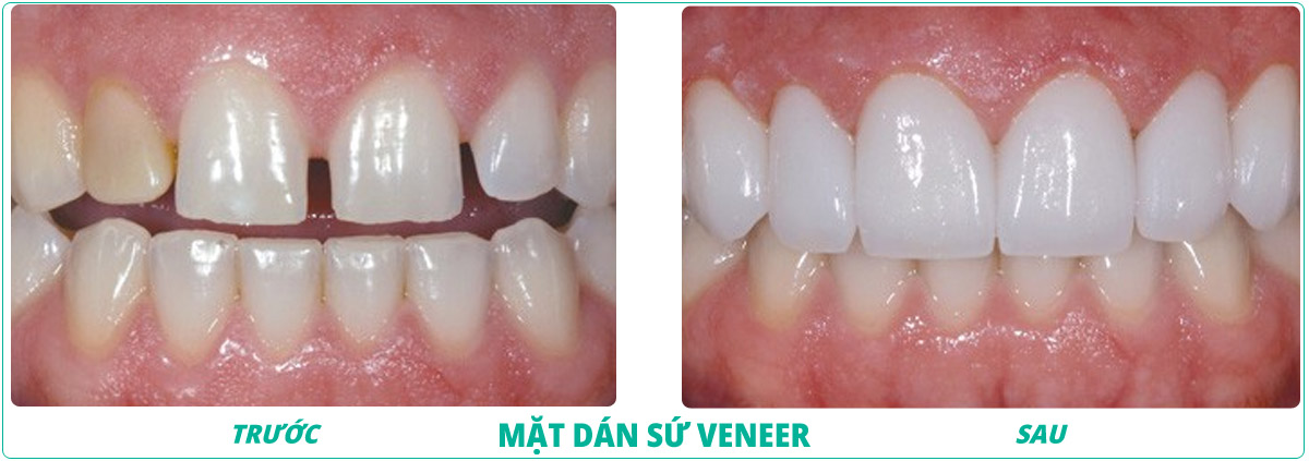 Quy trình dán sứ Veneer thẩm mỹ tại Nha khoa quận 12 chuẩn y khoa