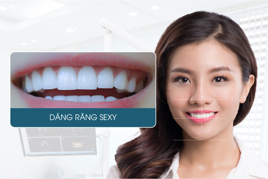Các dáng răng sứ được yêu thích hiện nay