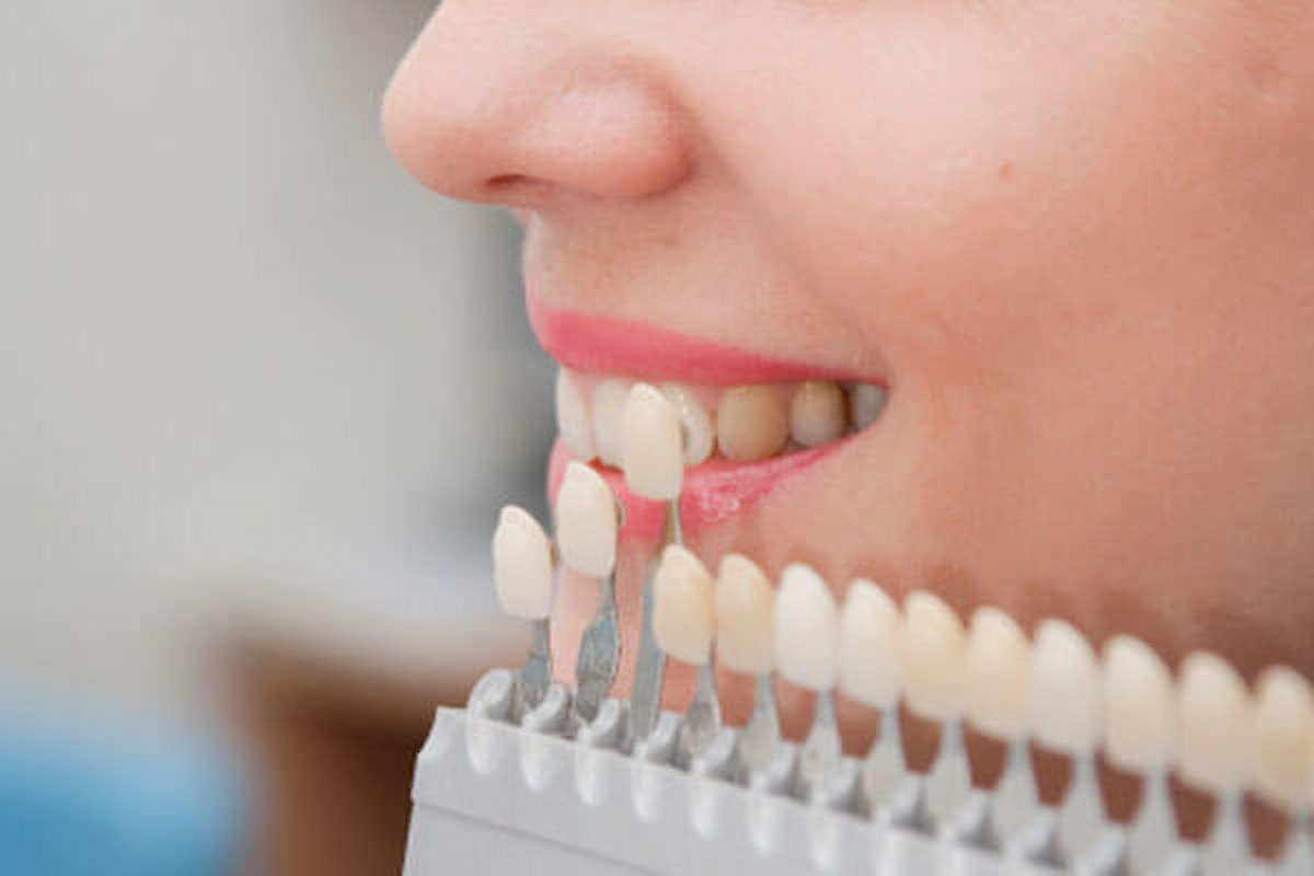 Bọc răng sứ Zirconia tại Nha khoa phường Trung Mỹ Tây