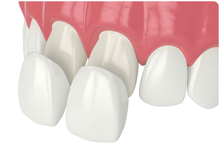 Dán Sứ Veneer Đẹp Tự Nhiên Tại Nha Khoa Phường Trung Mỹ Tây