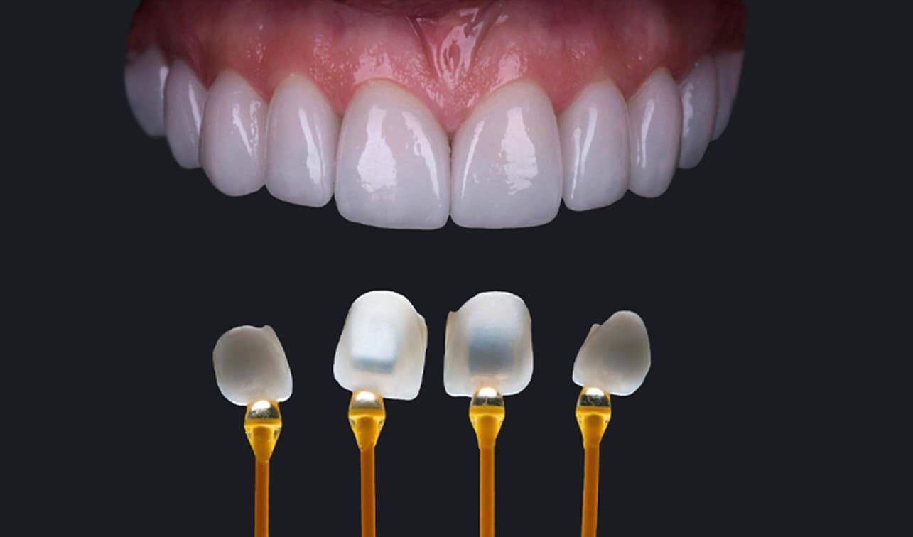 Dán sứ Veneer tại nha khoa gần đường Nguyễn Thị Búp