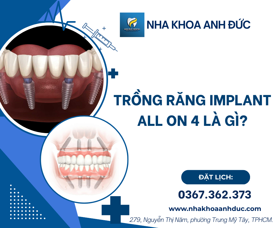 Trồng răng Implant All-on-4 là gì?