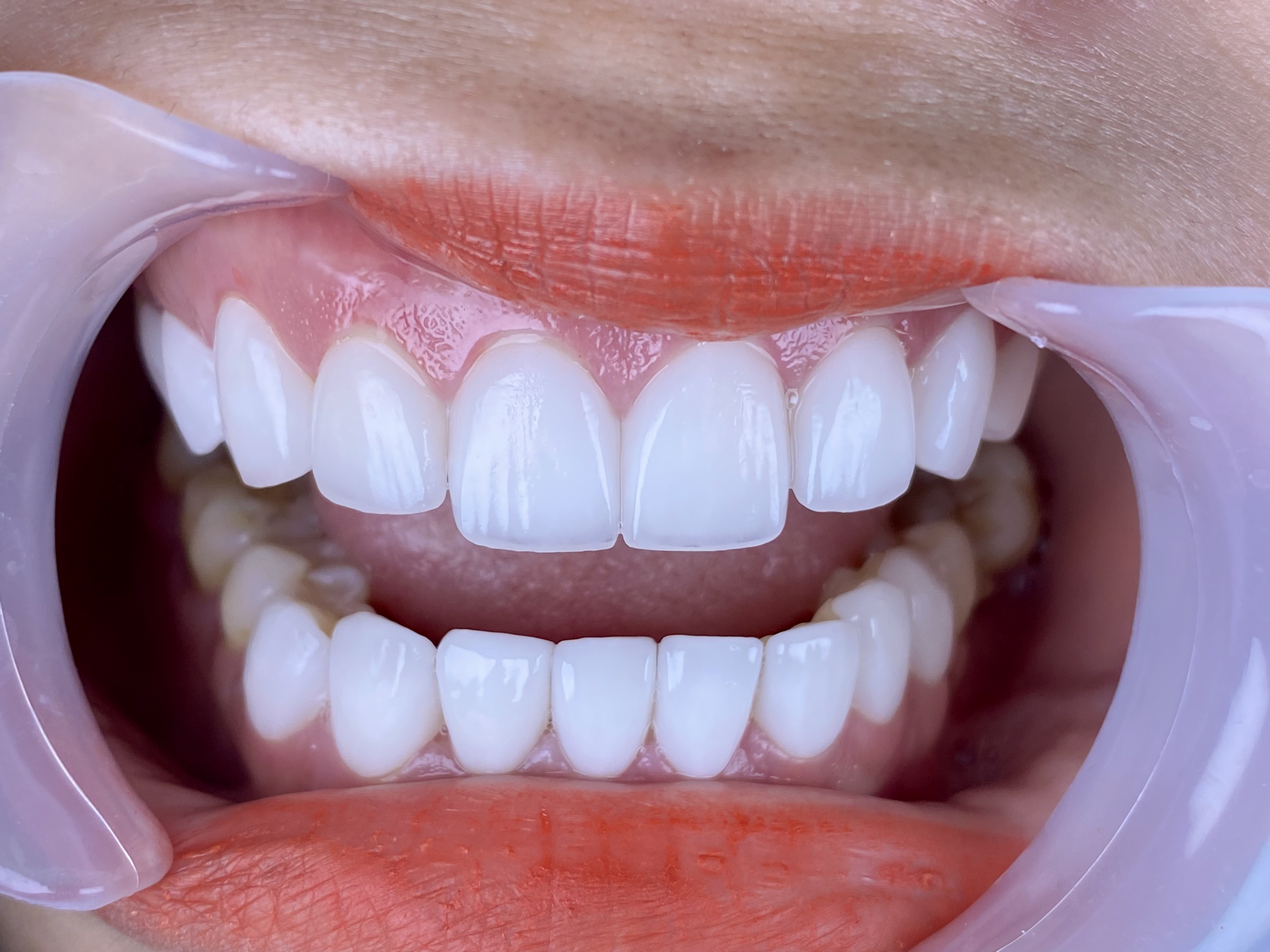 Nha khoa khoa dán sứ Veneer tại quận 12