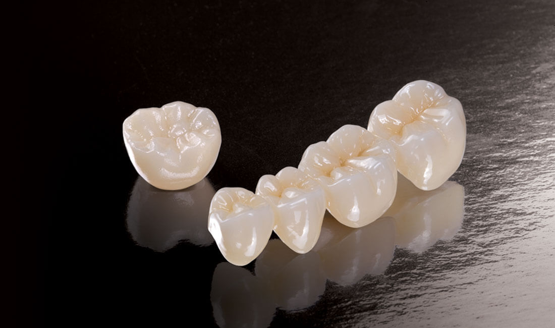 Những ưu điểm và hạn chế của răng sứ Zirconia