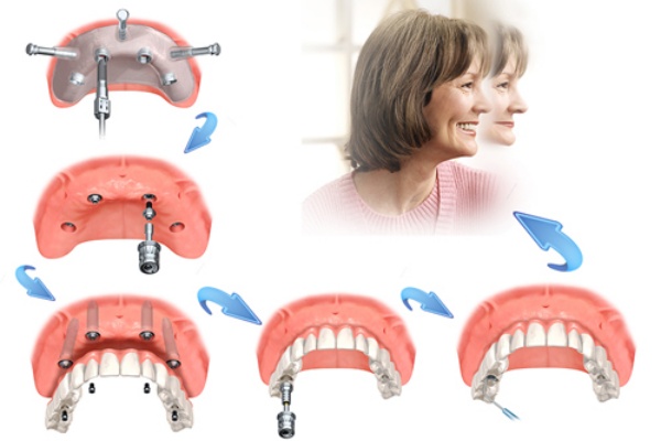 Trồng răng Implant All-on-4 giá bao nhiêu?