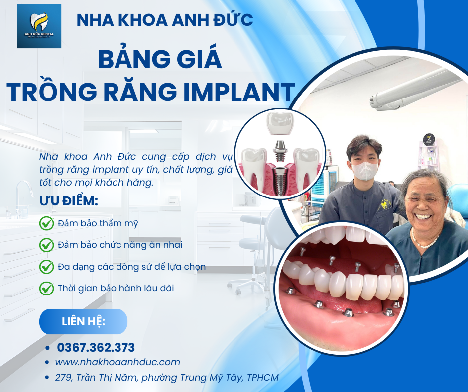 Bảng giá trồng răng implant quận 12 bao nhiêu tiền?