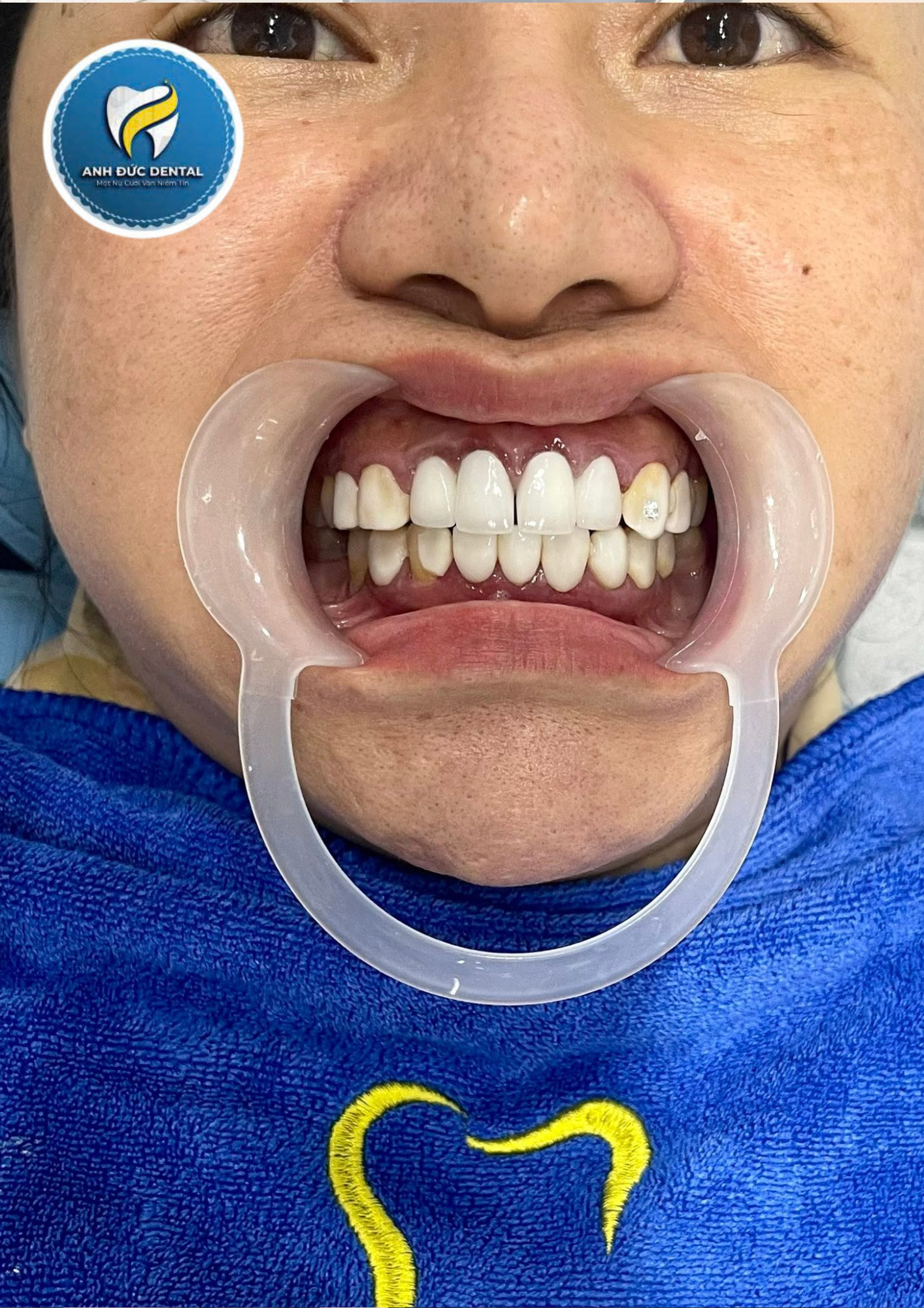 Hình ảnh tình trặng răng khách hàng trước khi đến với Anh Đức
