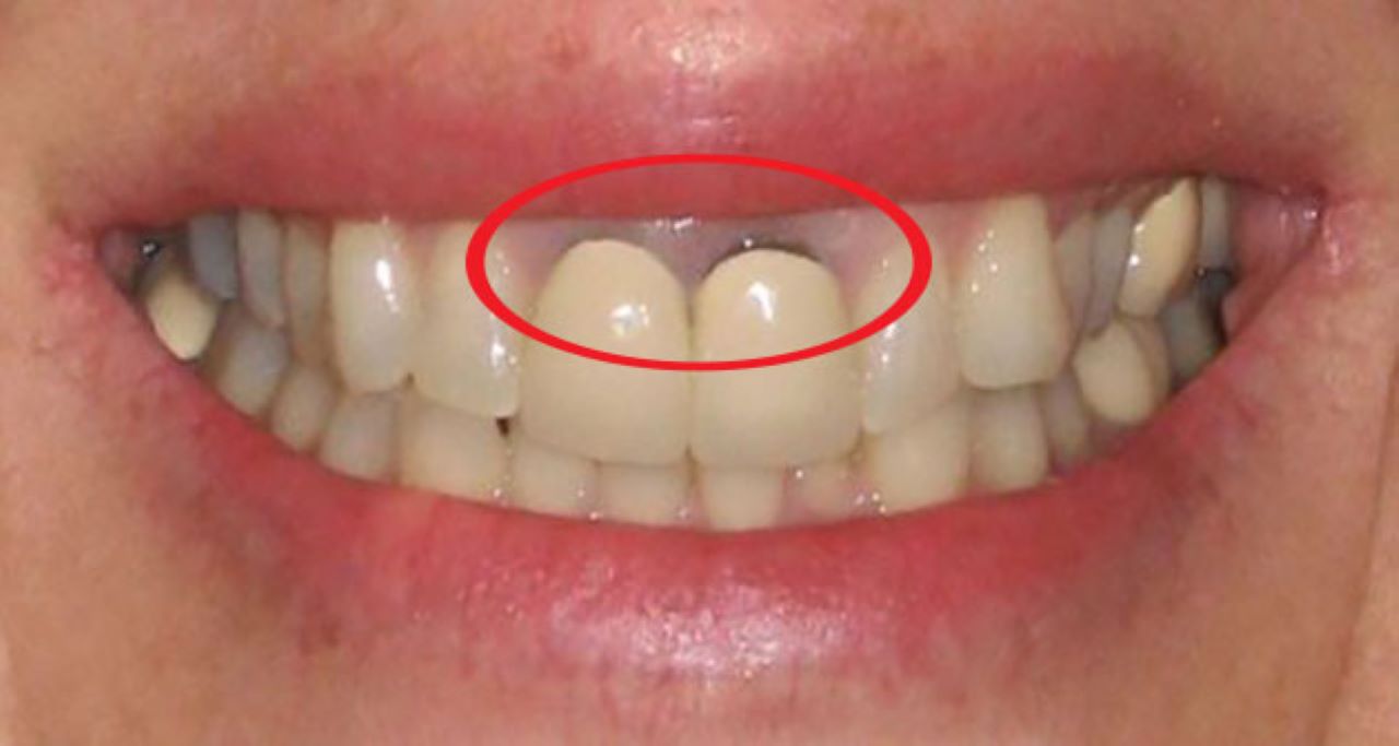 Hậu quả do bọc răng sứ sai cách gây ra