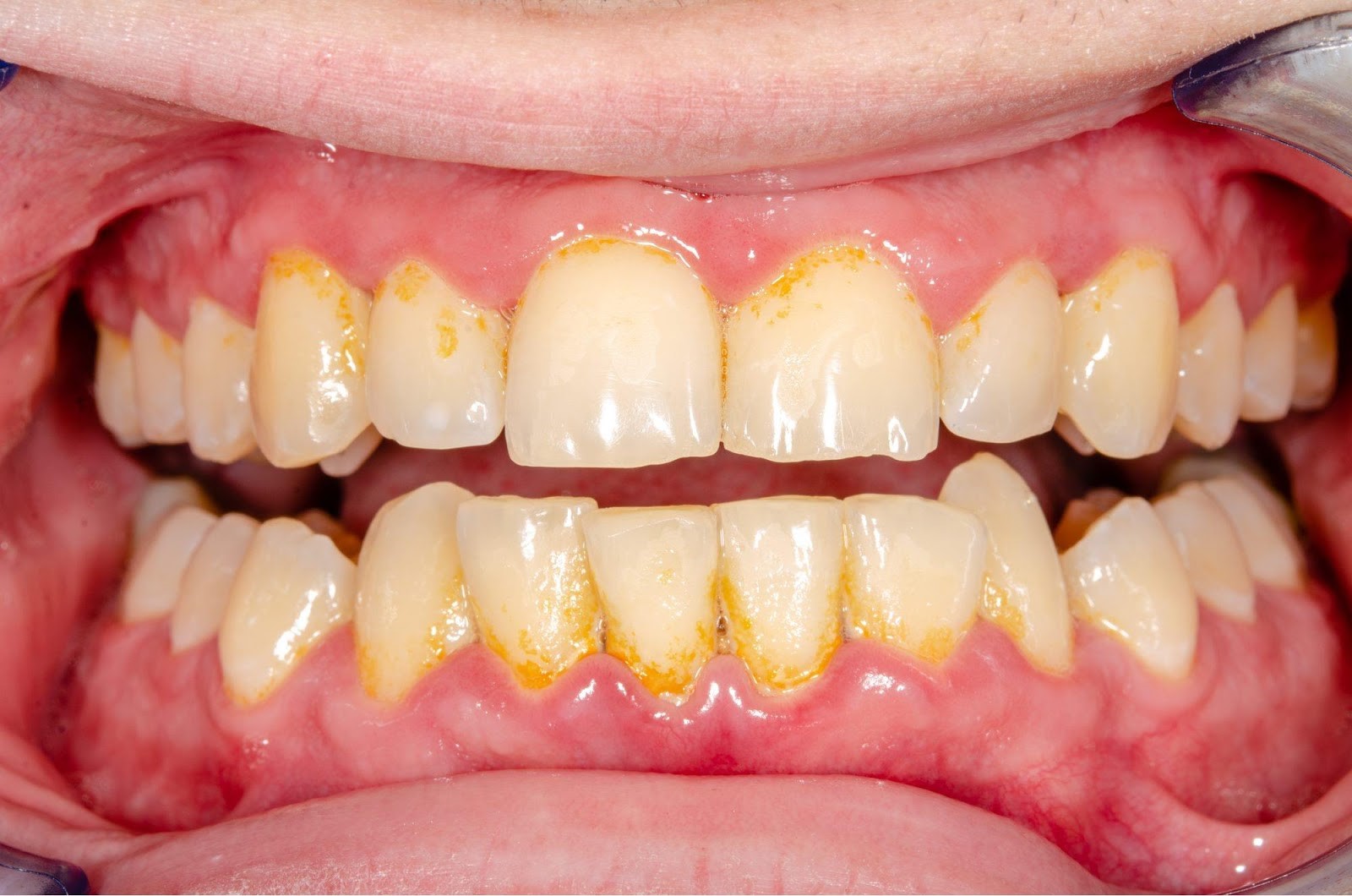 Khám răng định ky giúp loại bỏ vôi răng và vi khuẩn gây hại tích tụ