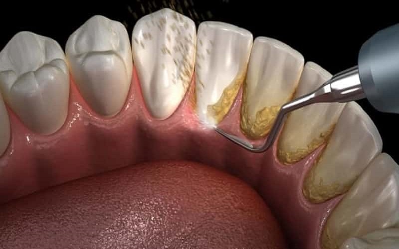 Cạo vôi răng tại nha khoa quận 12