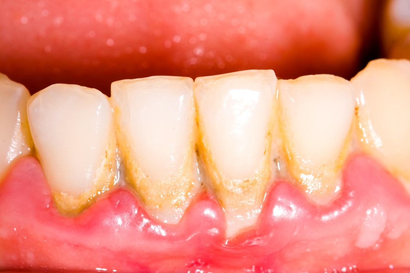 Cạo vôi răng tại nha khoa đường Trần Thị Năm