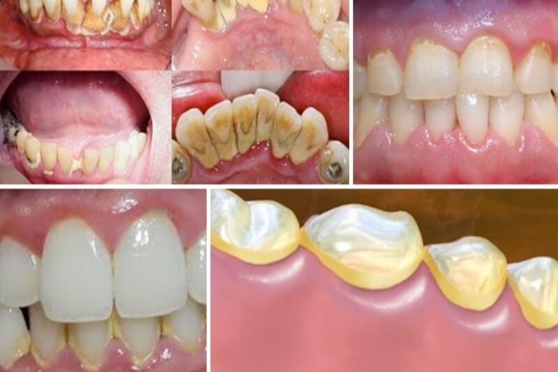 Cạo vôi răng tại nha khoa đường Trần Thị Năm