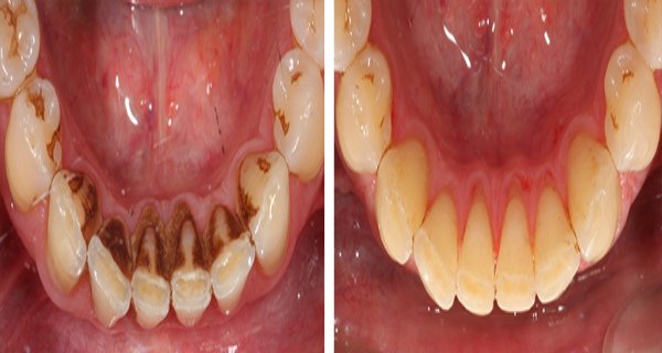 Cạo vôi răng tại nha khoa quận 12