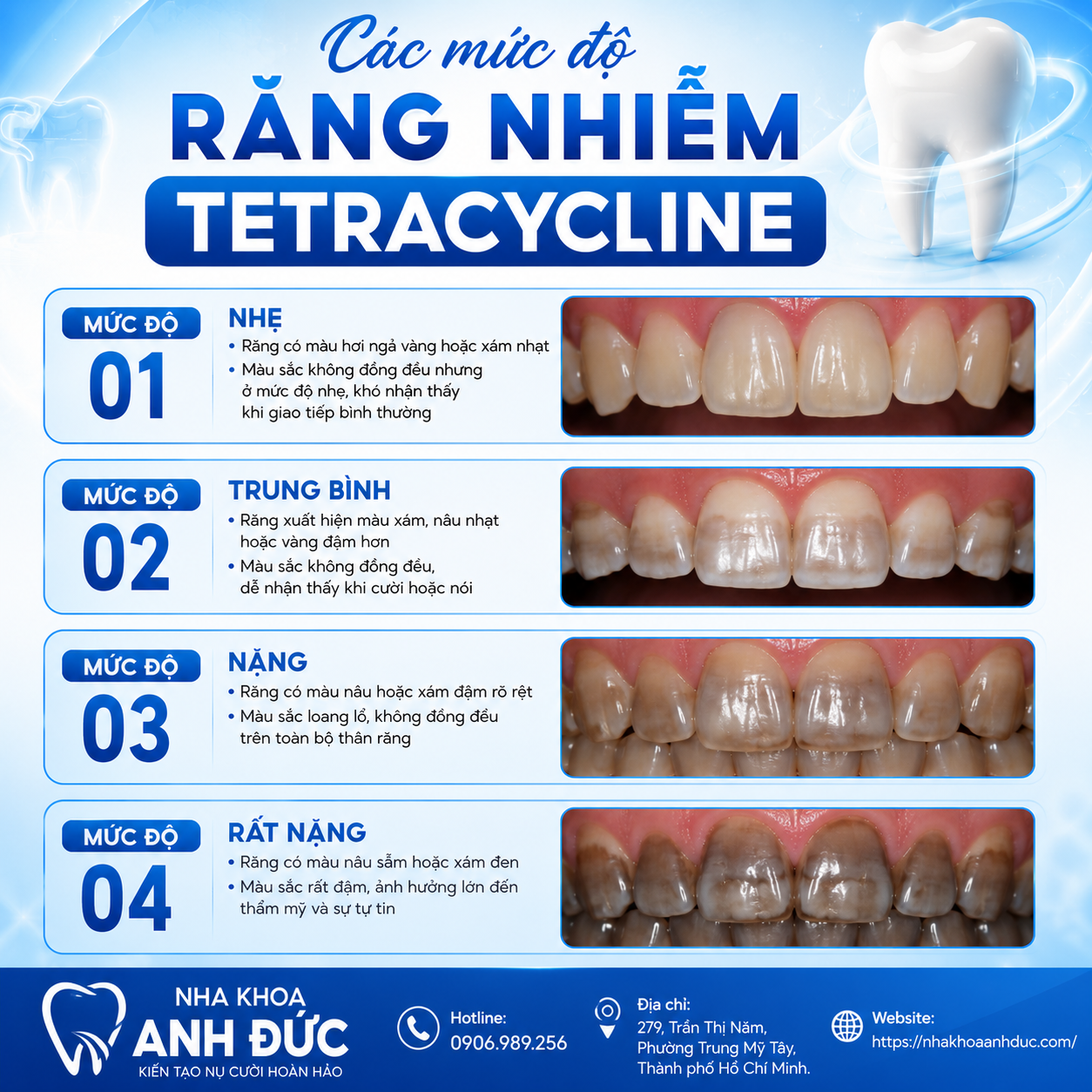Các mức độ răng nhiễm Tetracycline