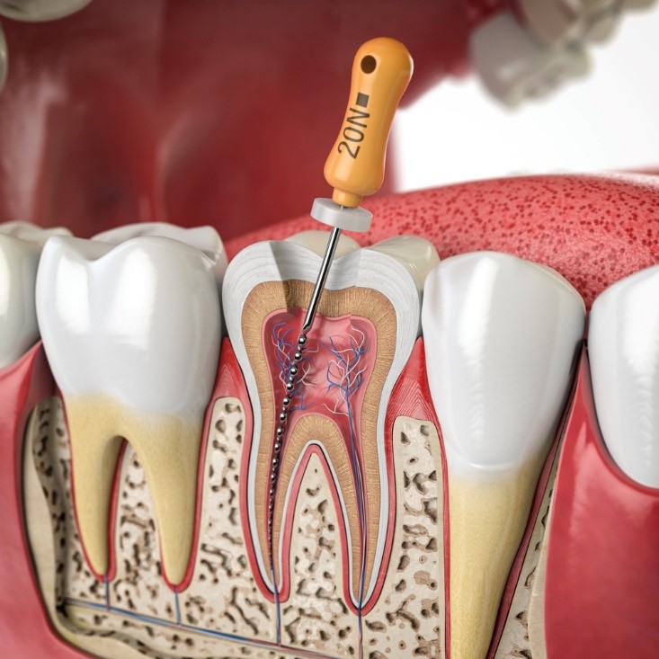 Nha khoa Anh Đức – Địa chỉ chữa tủy răng tại nha khoa phường Trung Mỹ Tây uy tín, không đau