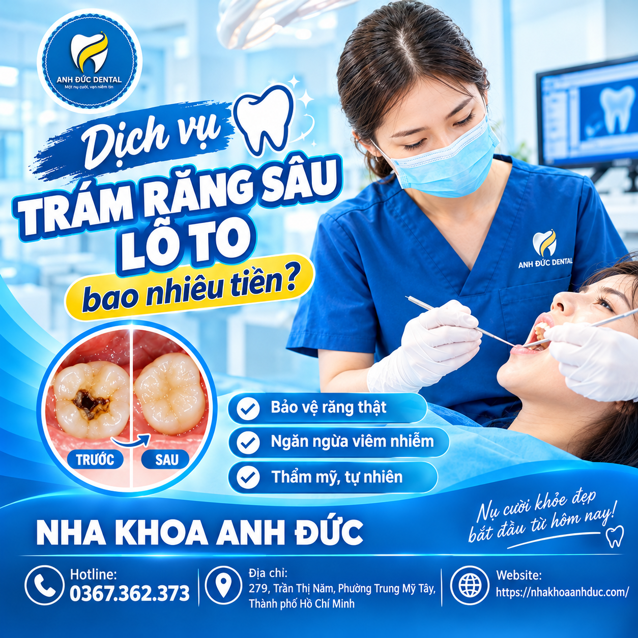 Dịch vụ trám răng sâu lỗ to bao nhiêu tiền?