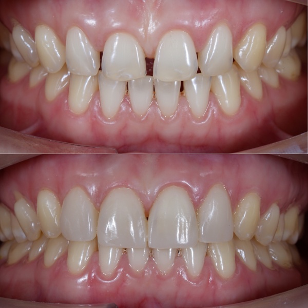 Vật liệu trám Composite thẩm mỹ