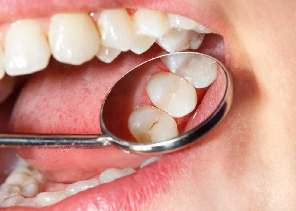 Dịch vụ trám răng sâu lỗ to bao nhiêu tiền?