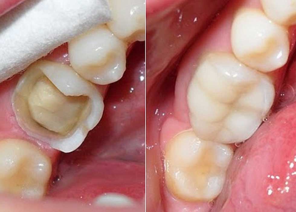 Dịch vụ trám răng sâu lỗ to bao nhiêu tiền?