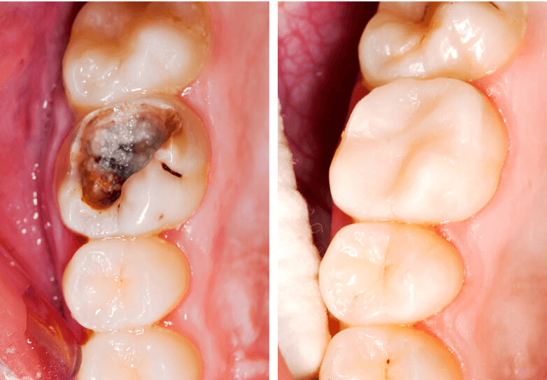 Dịch vụ trám răng tại nha khoa phường Trung Mỹ Tây