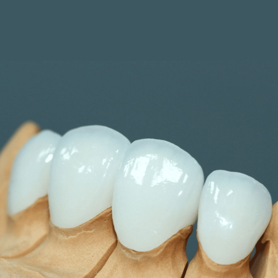 Răng sứ lava- dòng sứ cao cấp quốc tế