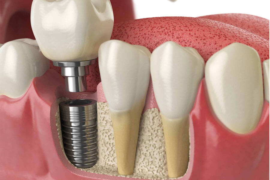 Địa chỉ trồng răng implant uy tín gần chợ Hóc Môn