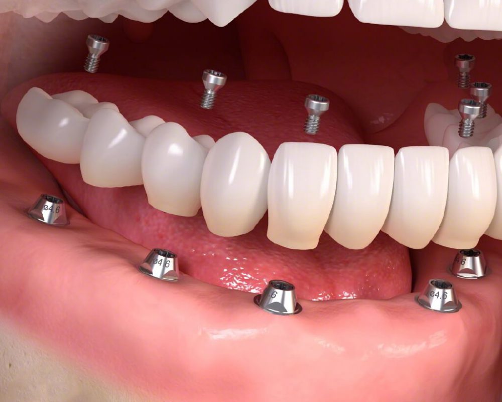 Địa chỉ trồng răng implant uy tín gần chợ Hóc Môn