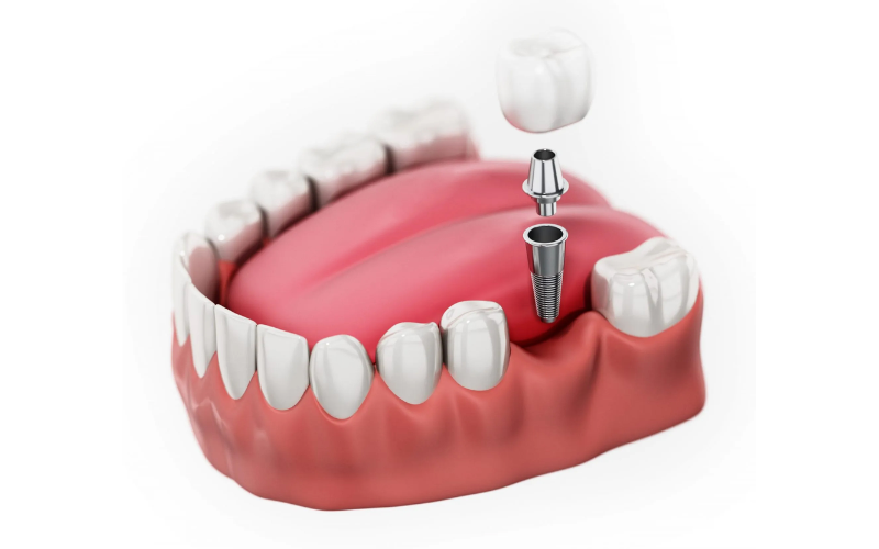 Giới thiệu tổng quan về Nha khoa Anh Đức – Điểm đến phục hình cấy ghép răng tin cậy