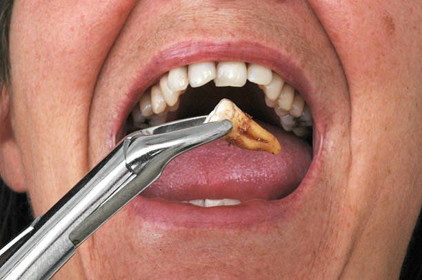 Nhổ răng tại nha khoa gần đường Nguyễn Thị Búp