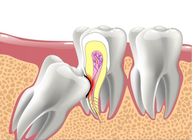 Nhổ răng khôn tại nha khoa phường Trung Mỹ Tây