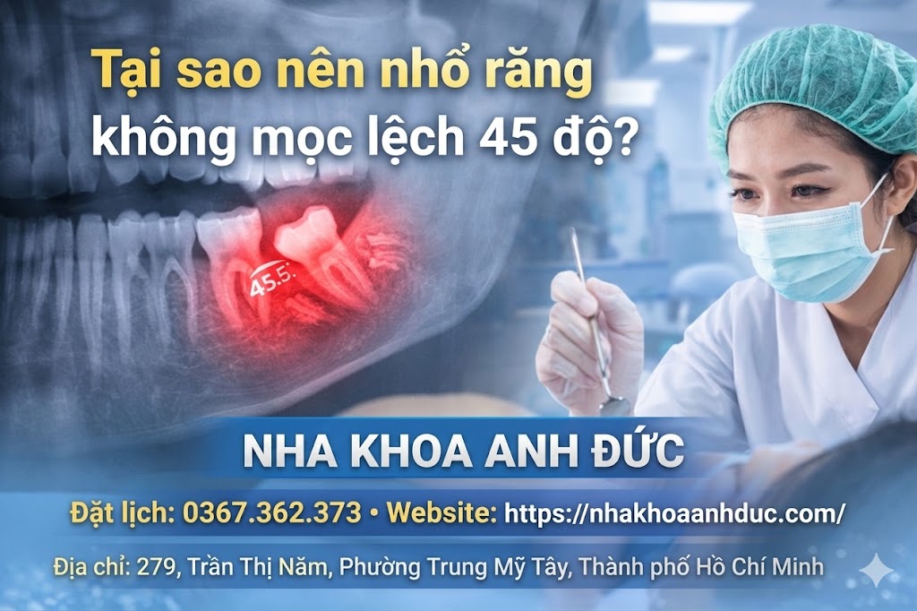 Tại sao nên nhổ răng không mọc lệch 45 độ?